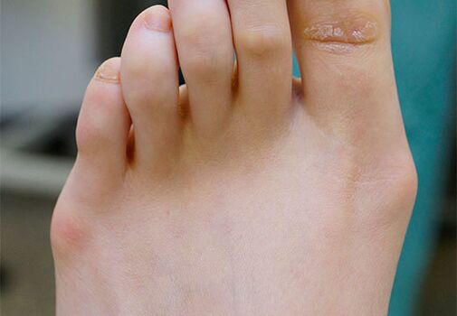 „Valgus Foot“