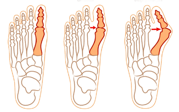 „Hallux Valgus“ deformacija