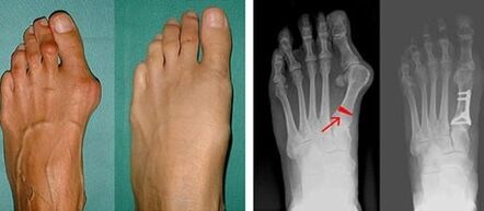 hallux valgus simptomai