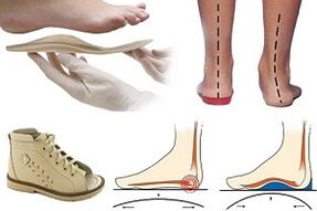 ortopediniai batai hallux valgus vaikui