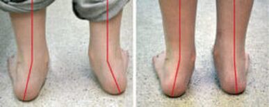 „Valgus“ kreivumas